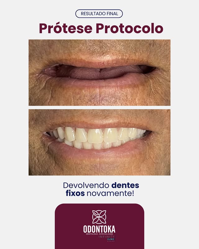 Resultado final de prótese protocolo — antes e depois devolvendo dentes fixos